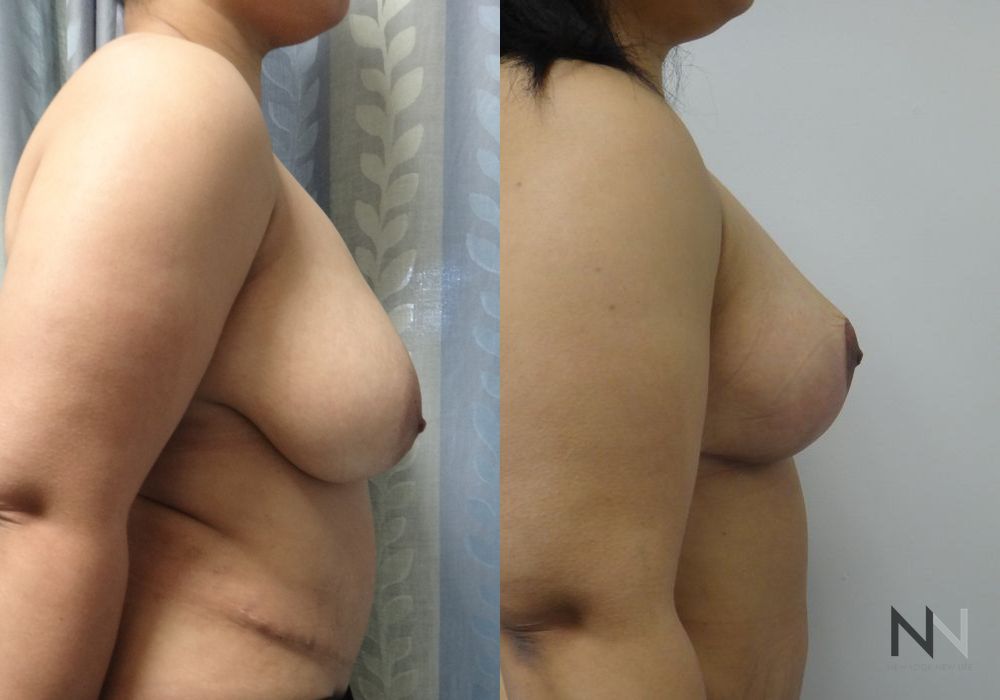 Breast Lift - Thumbnail 2