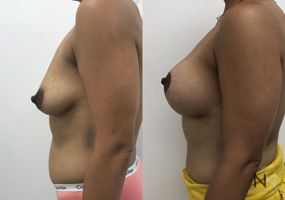 Breast Lift - Thumbnail 5