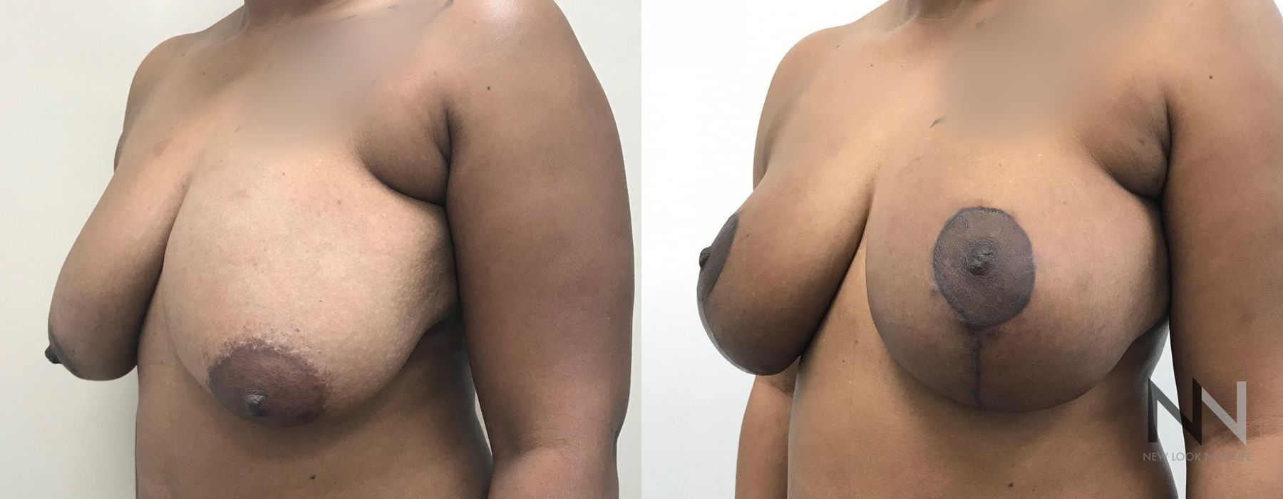 Breast Lift - Case 2029