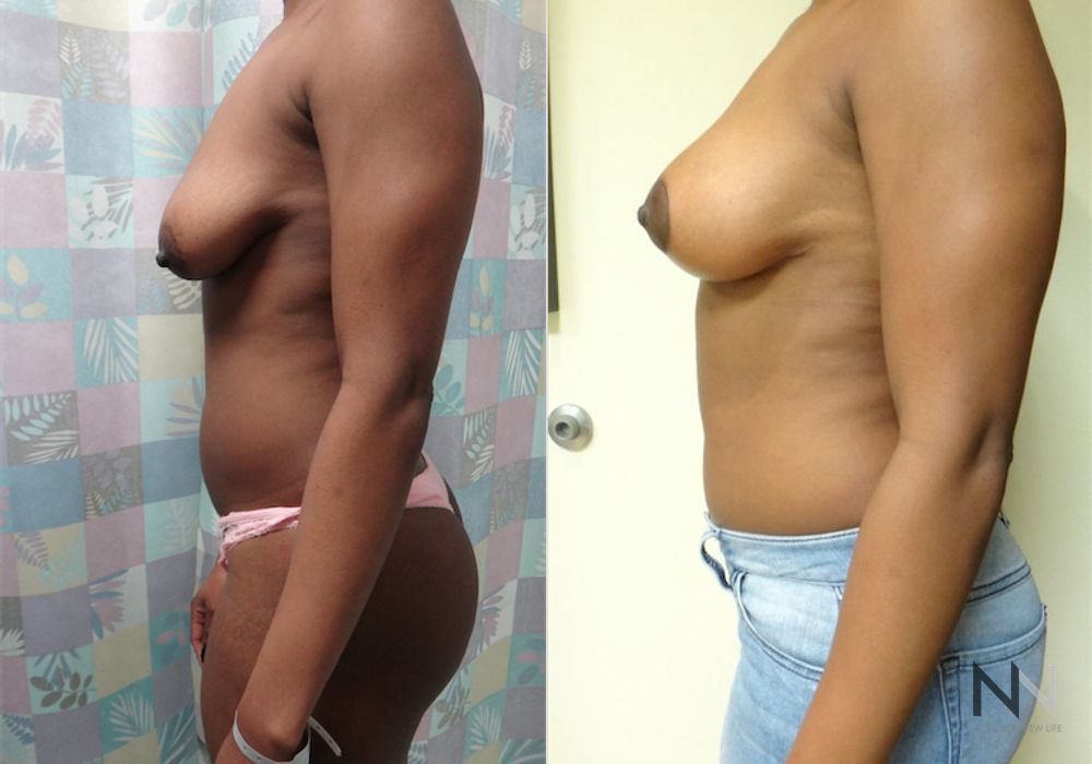 Breast Lift - Thumbnail 3