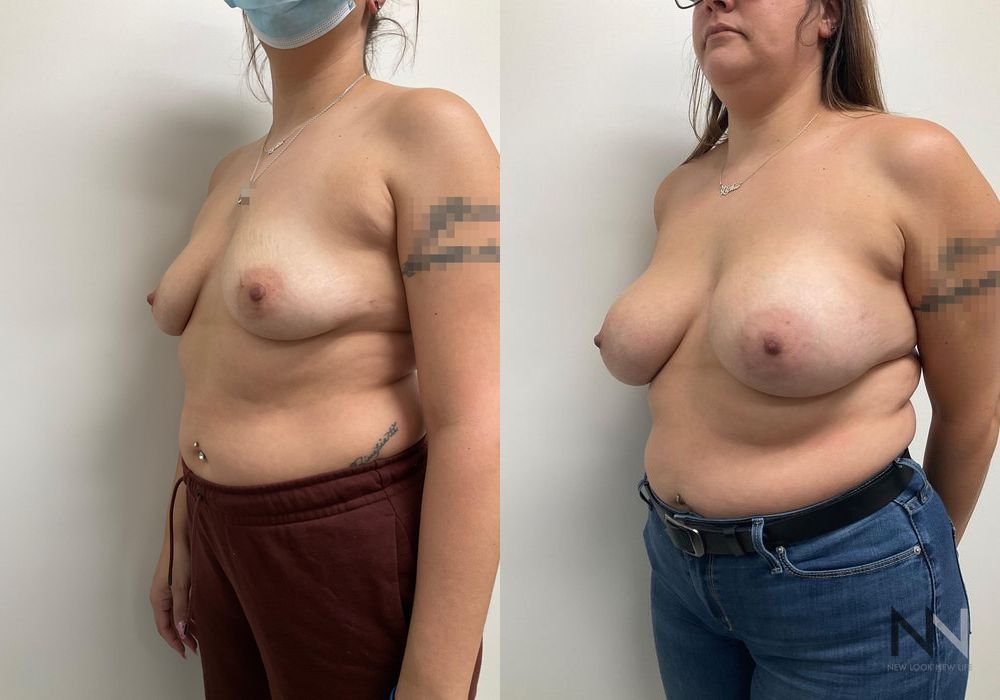 Breast Lift - Thumbnail 2