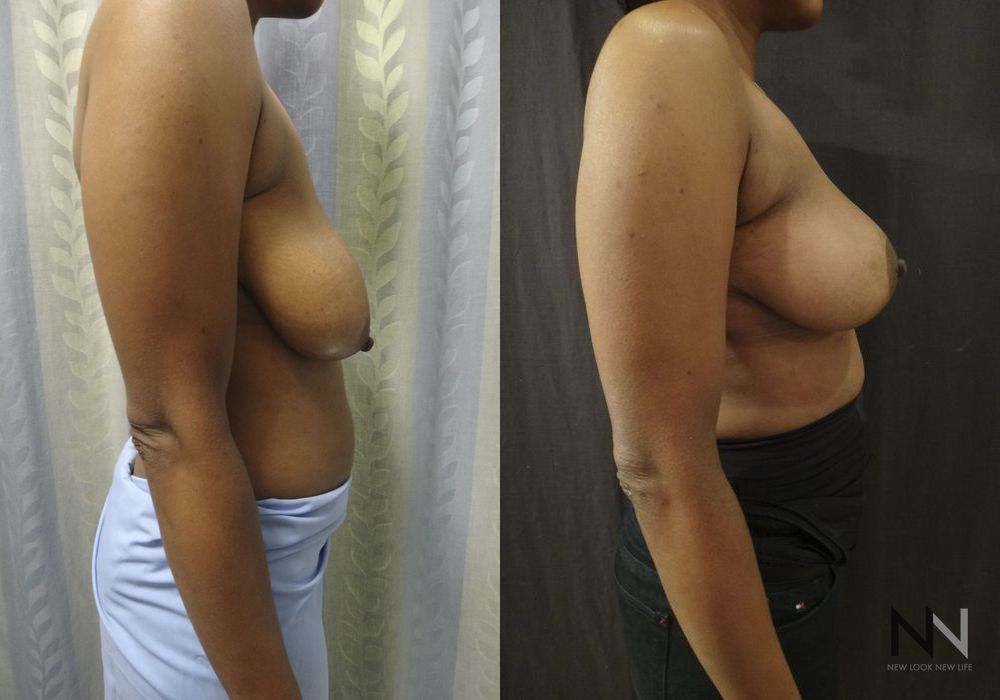 Breast Lift - Thumbnail 5