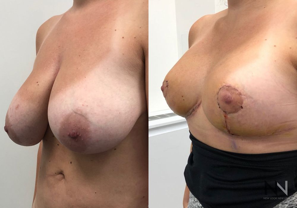 Breast Lift - Thumbnail 3