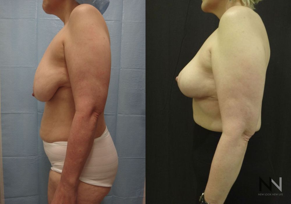 Breast Lift - Thumbnail 5