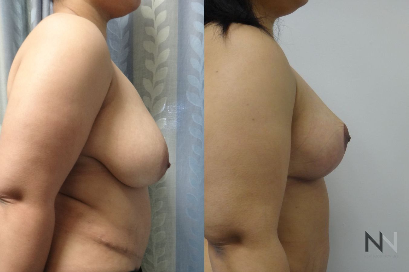 Anchor mastopexy showing elevated breast contour - Angle 2