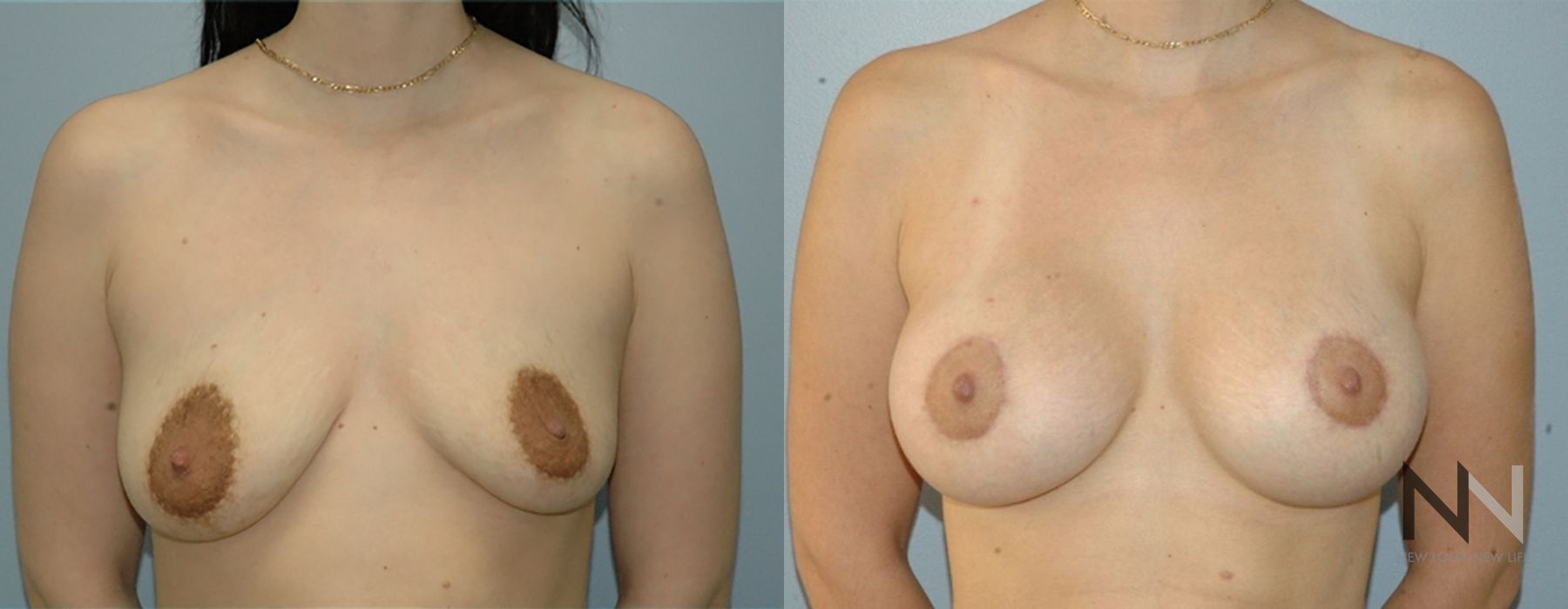 Breast Lift - Case 2030