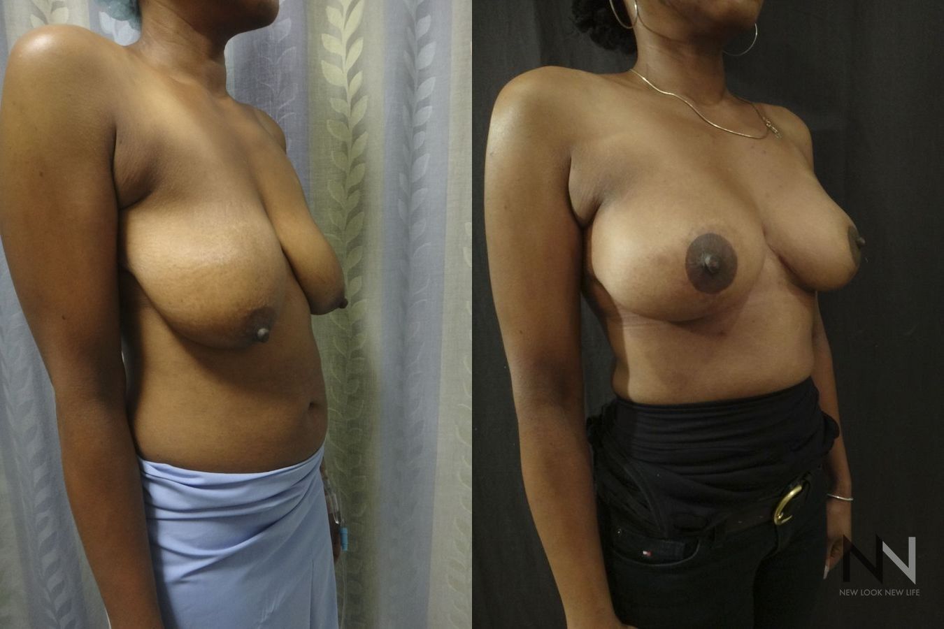 Breast contour improvement after mastopexy surgery - Angle 4