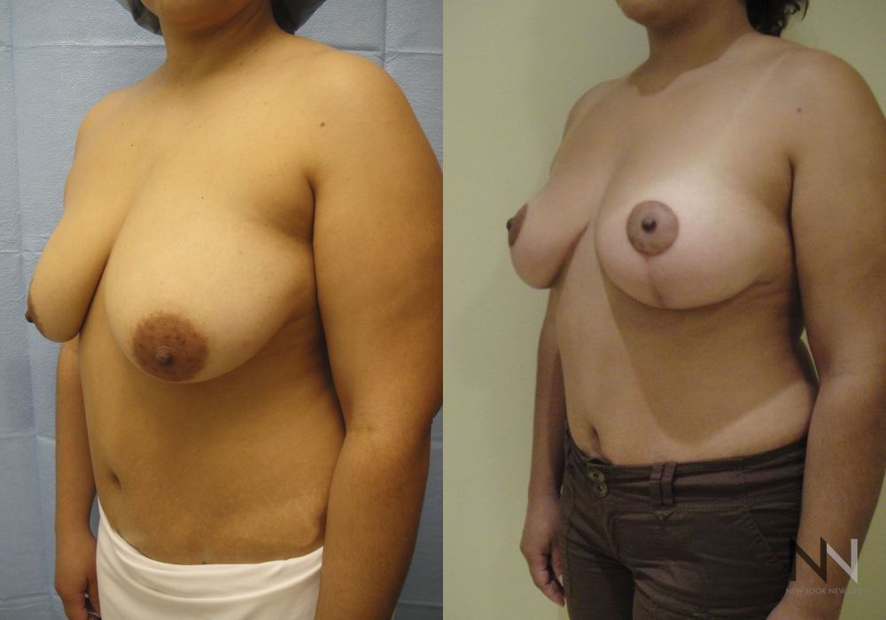Breast Lift - Thumbnail 3