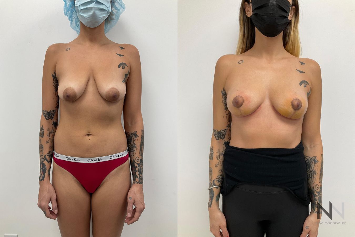 Before and after breast lift six months results