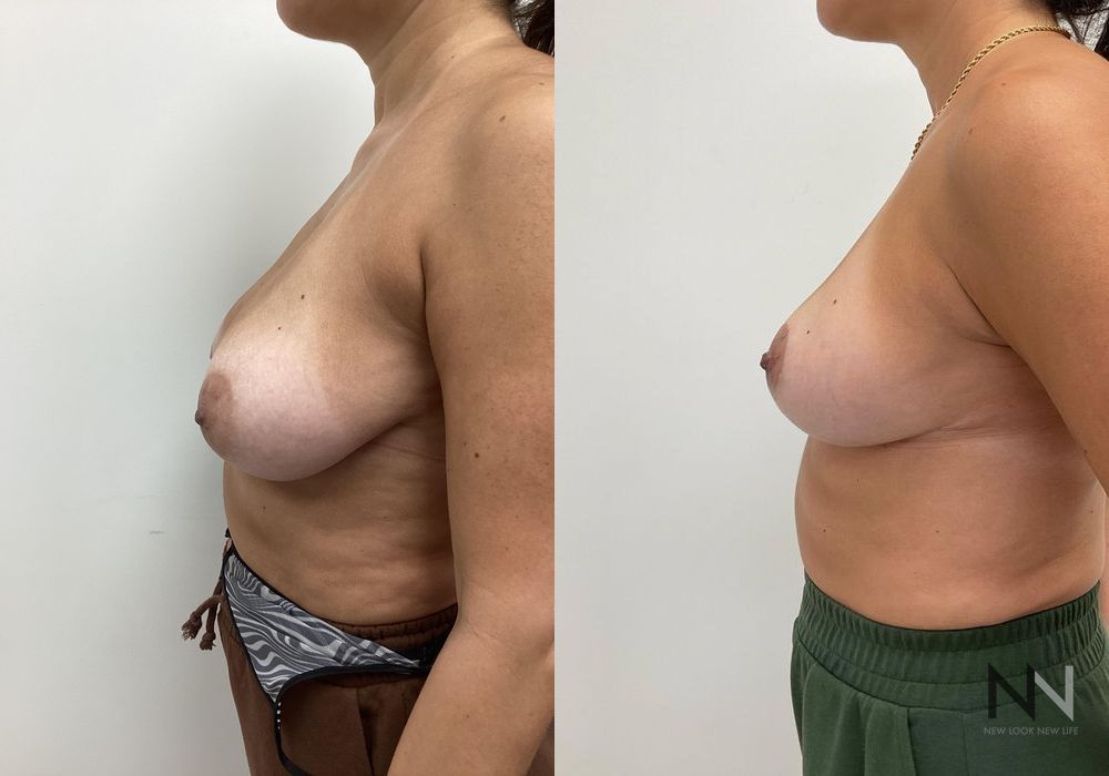Breast Lift - Case 2024