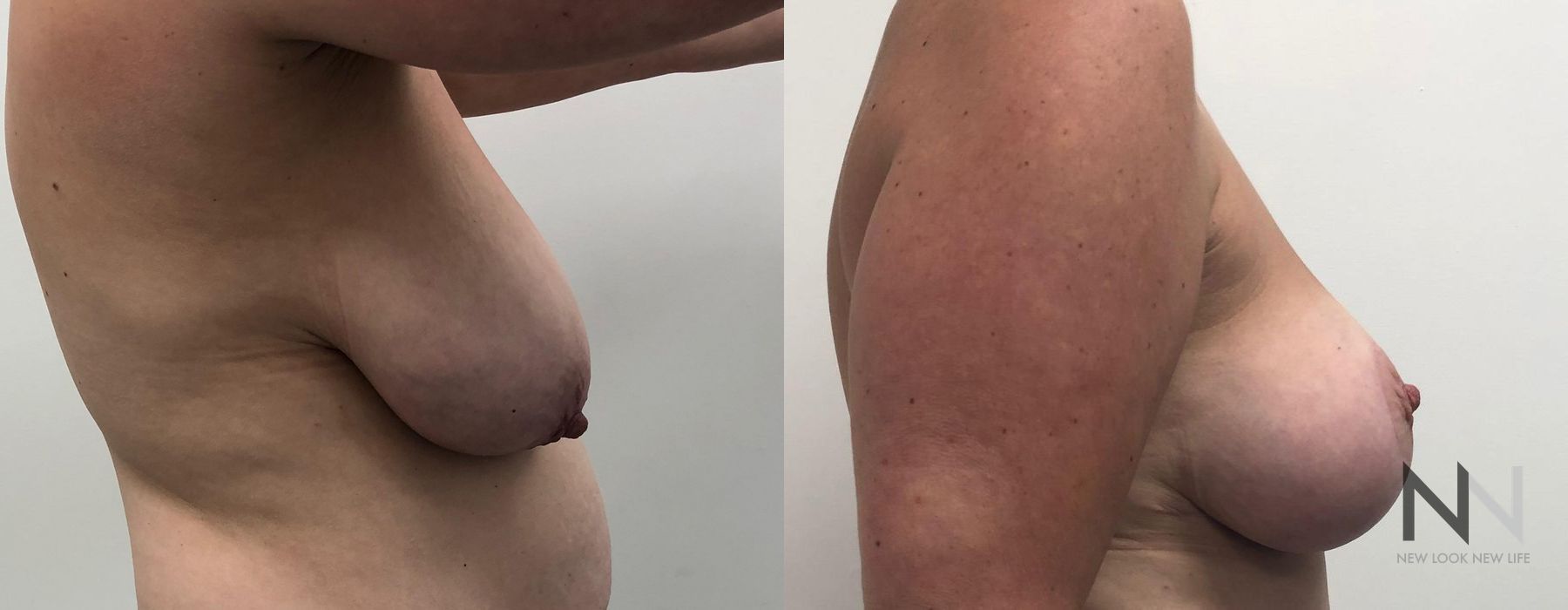 Breast Lift - Thumbnail 2