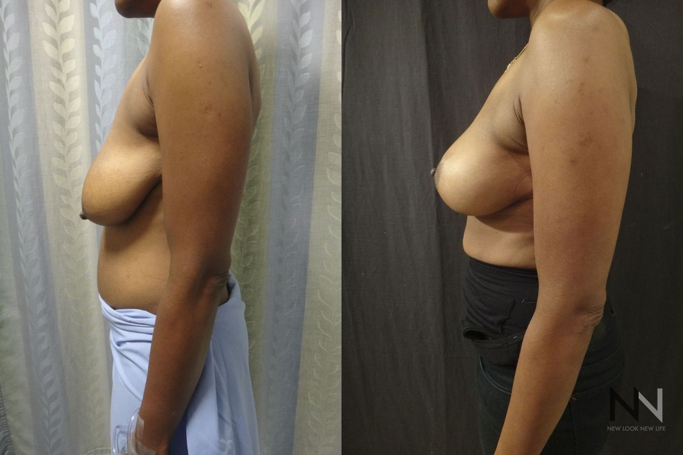 Breast contour improvement after mastopexy surgery - Angle 3