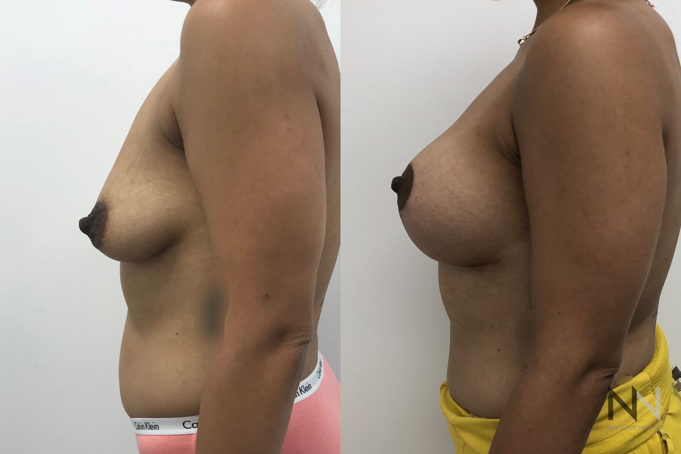Before and after breast augmentation six months results - Angle 5