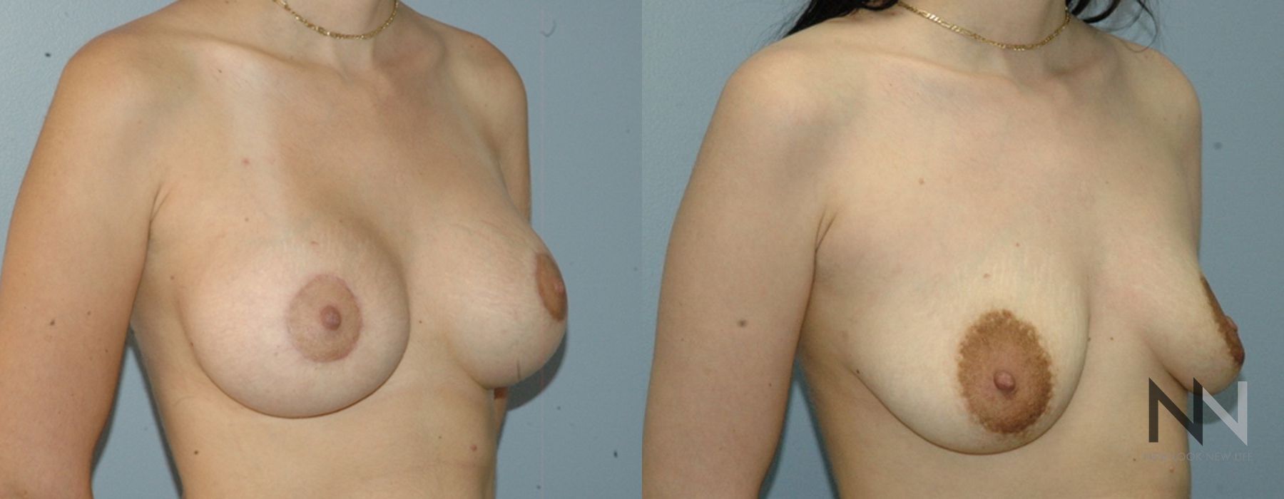 Breast Lift - Thumbnail 2