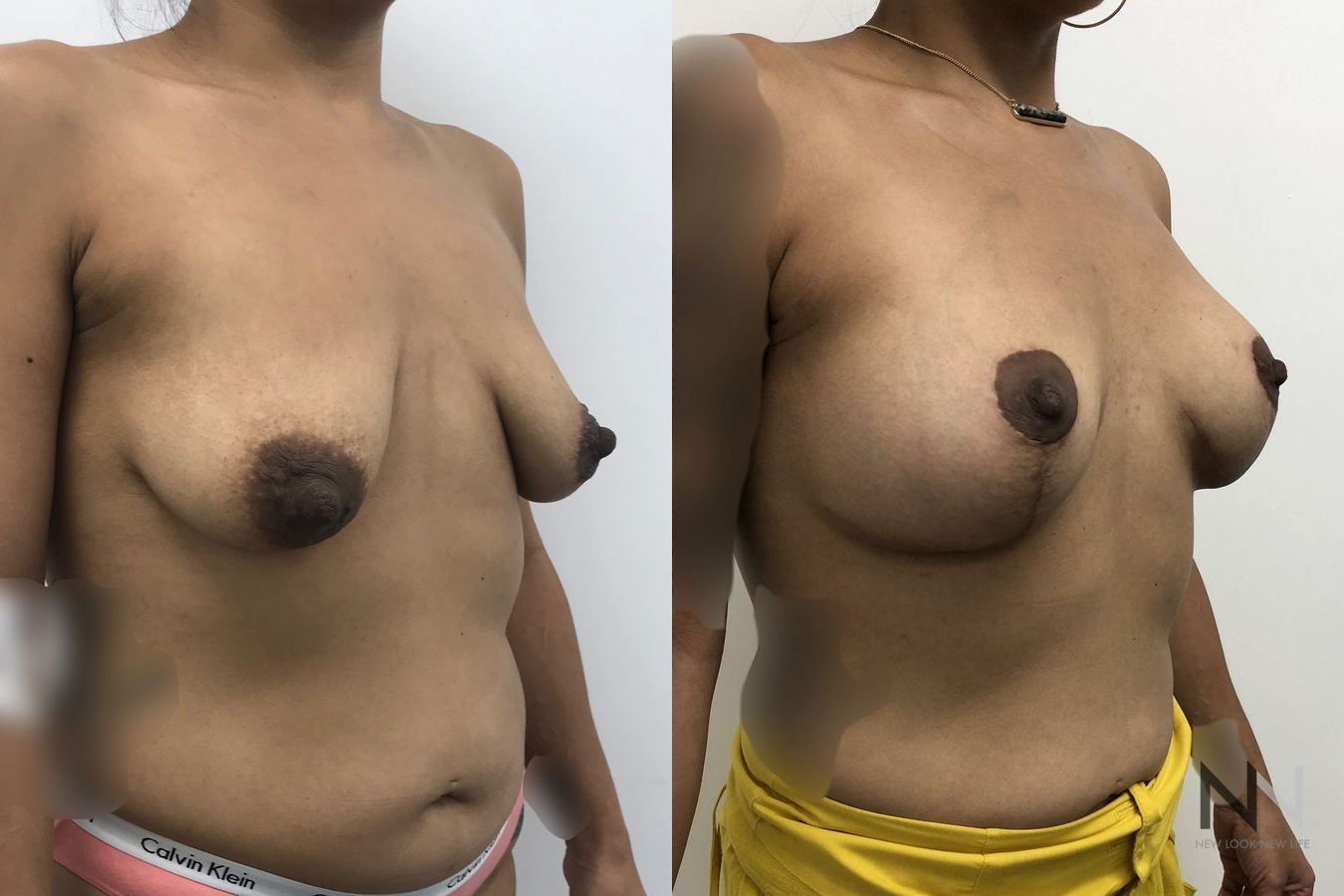 Before and after breast augmentation six months results - Angle 2