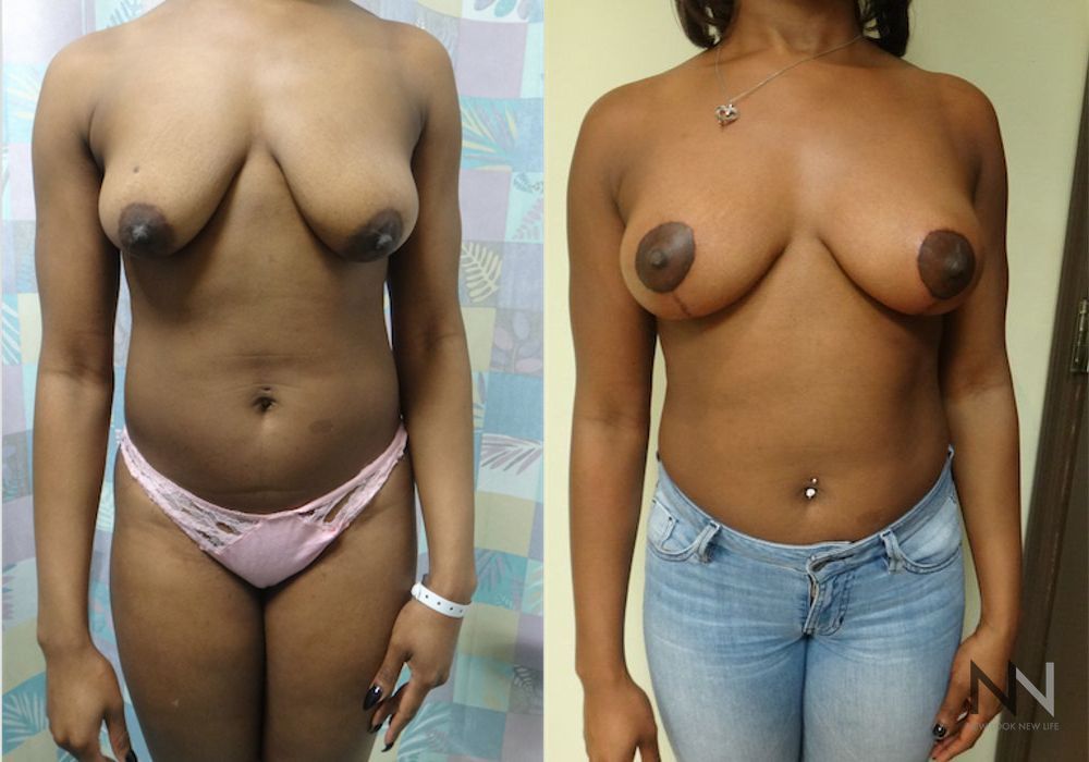 Breast Lift - Case 2020