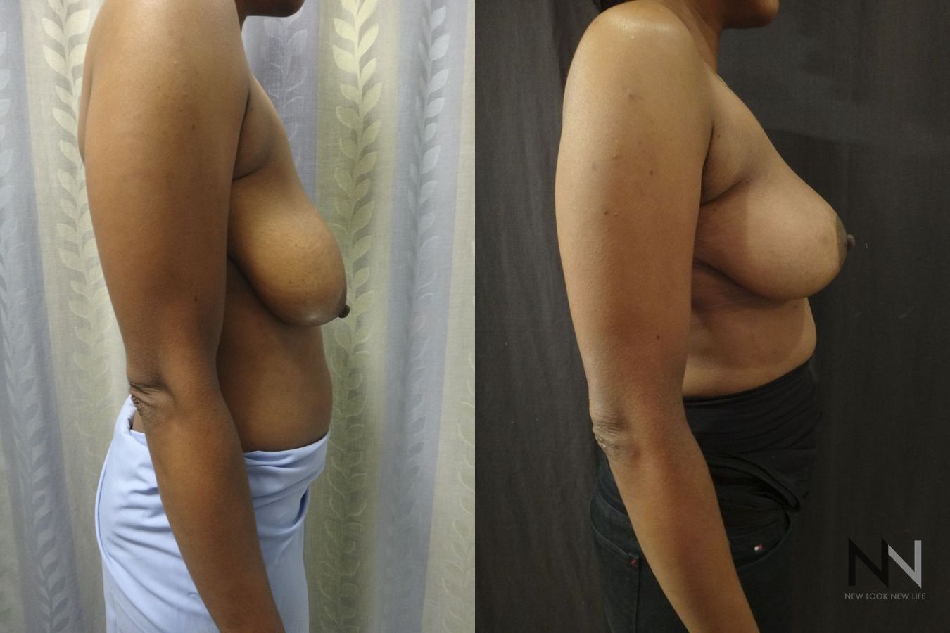 Breast contour improvement after mastopexy surgery - Angle 5
