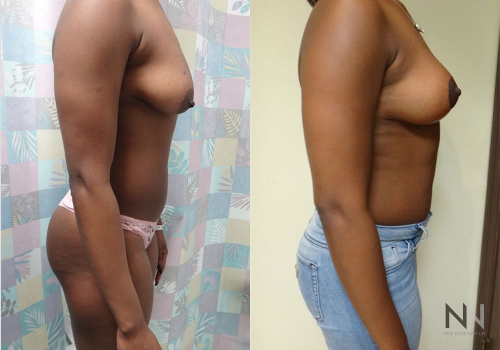 Breast Lift - Thumbnail 2