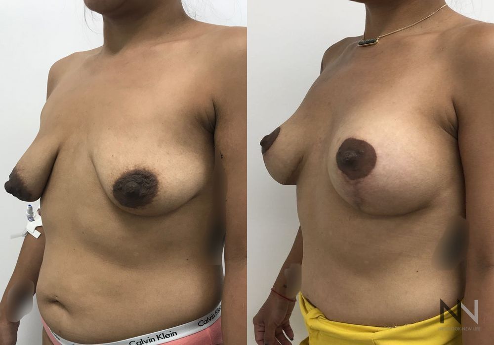 Breast Lift - Thumbnail 2