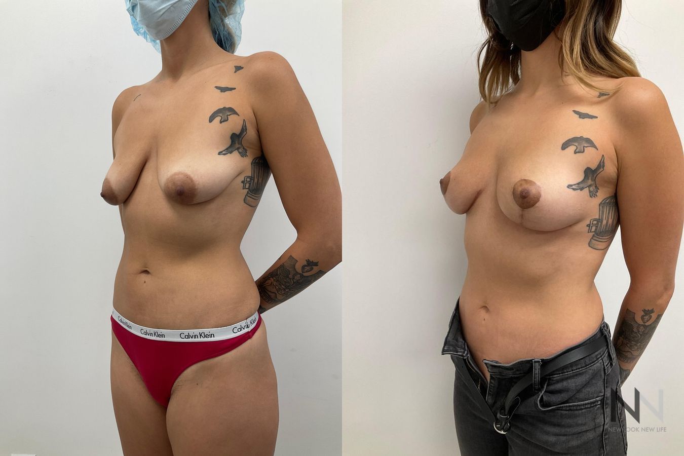 Before and after breast lift six months results - Angle 2