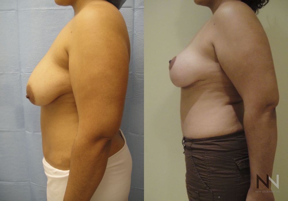 Breast Lift - Thumbnail 5