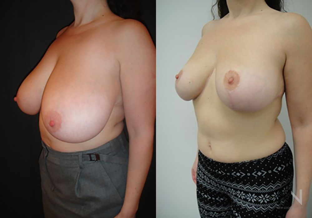 Breast Reduction - Thumbnail 2