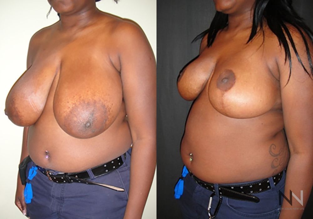 Breast Reduction - Thumbnail 2