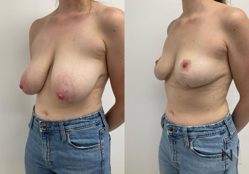 Before and after Breast Reduction case 21238 - Angle 2