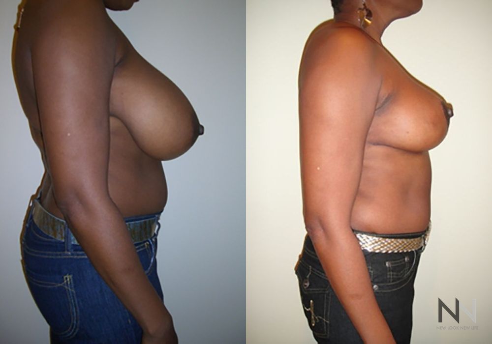 Breast Reduction - Thumbnail 5