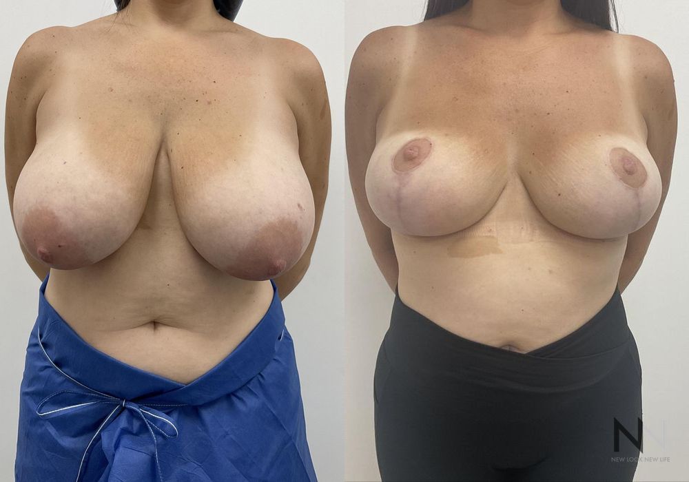 Breast Reduction - Thumbnail 3