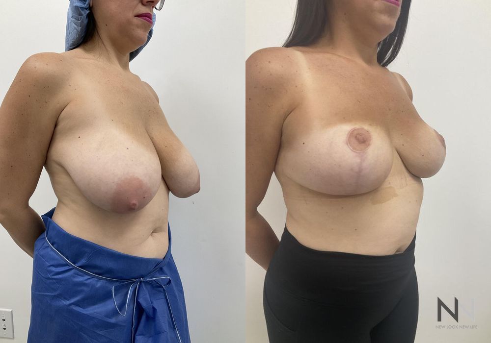 Breast Reduction - Thumbnail 2