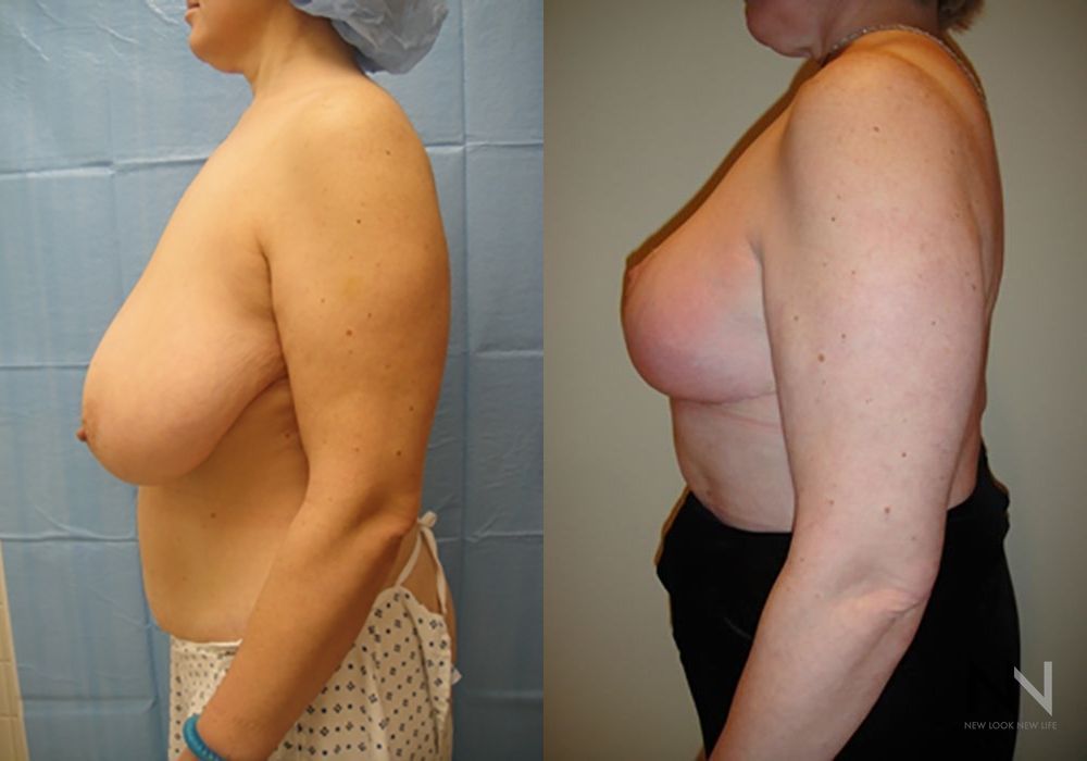 Breast Reduction - Thumbnail 2