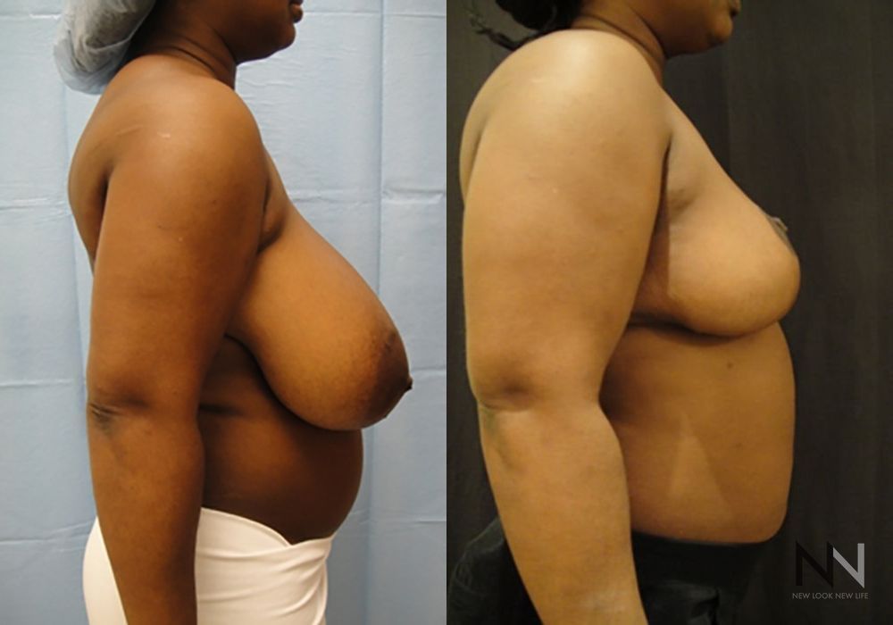 Breast Reduction - Thumbnail 5