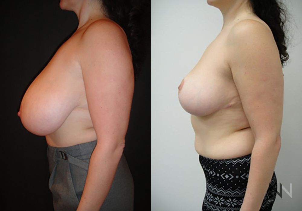 Breast Reduction - Thumbnail 3
