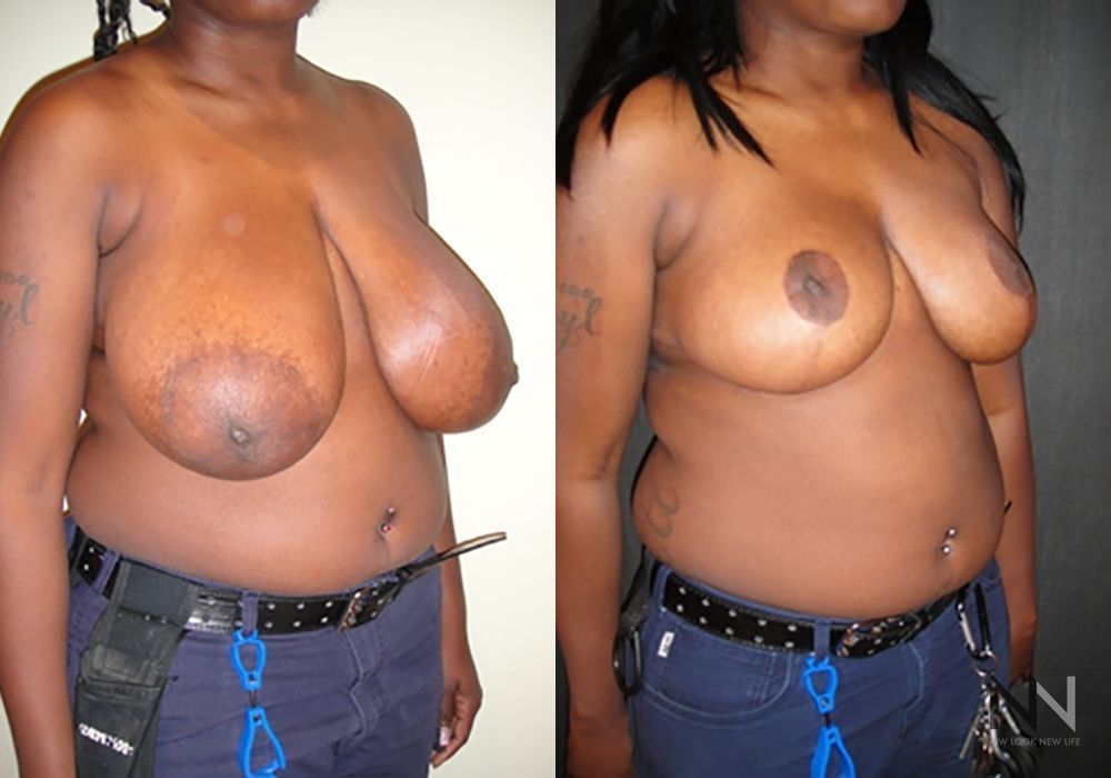 Breast Reduction - Thumbnail 4