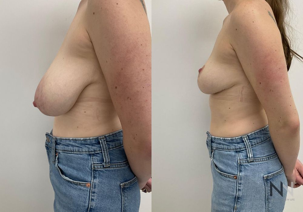 Before and after Breast Reduction case 21238 - Angle 3