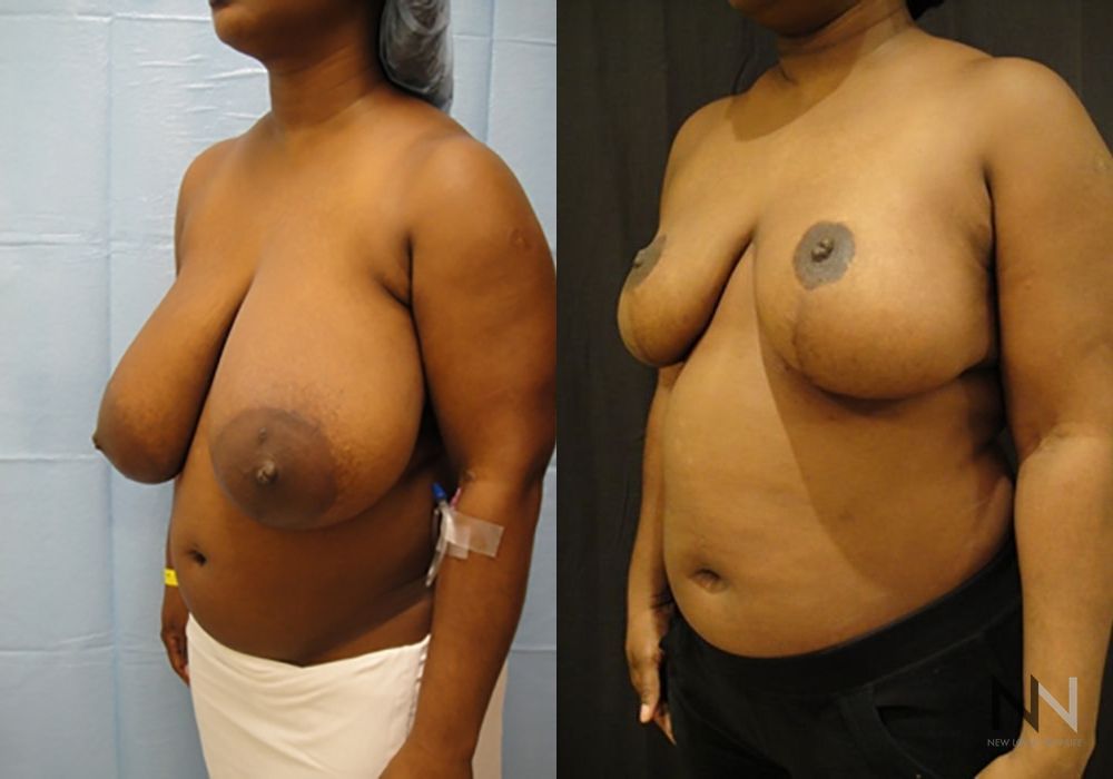 Breast Reduction - Thumbnail 2