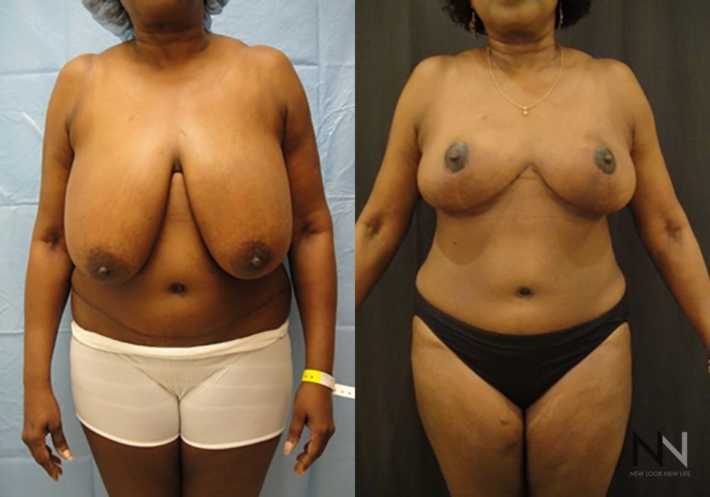 Breast Reduction - Case 2042