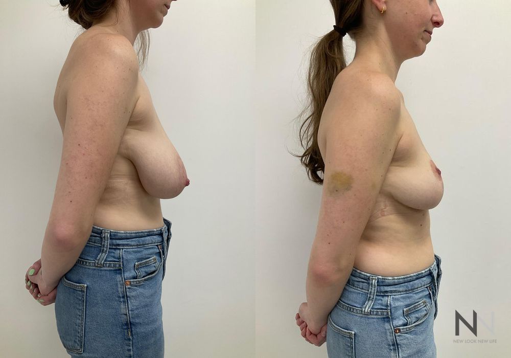 Breast Reduction - Thumbnail 3