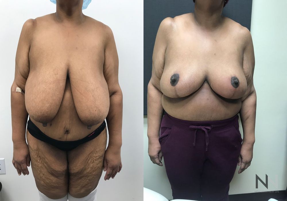 Breast Reduction - Case 1853