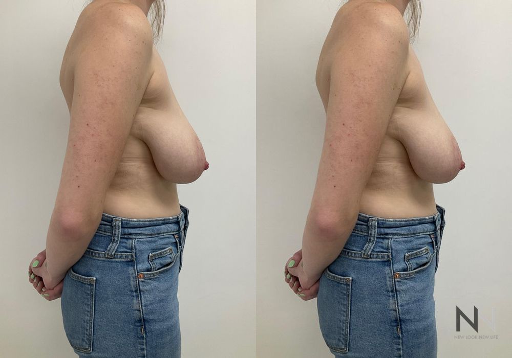 Before and after Breast Reduction case 21003 - Angle 2