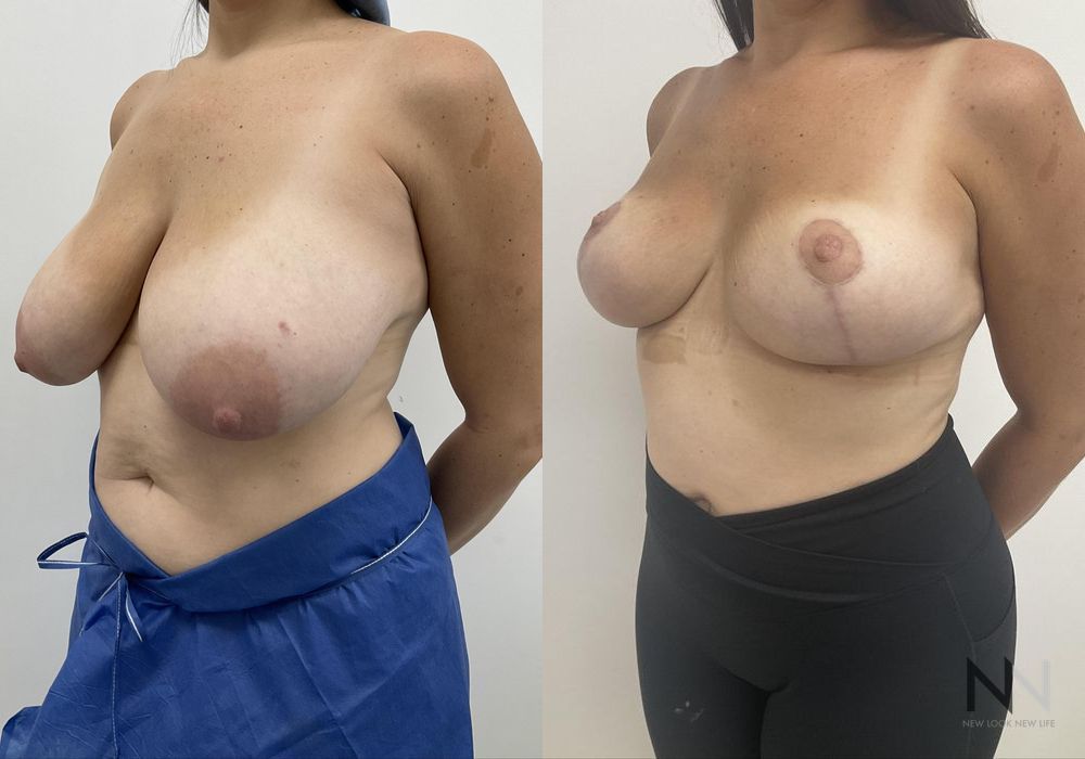 Breast Reduction - Thumbnail 4