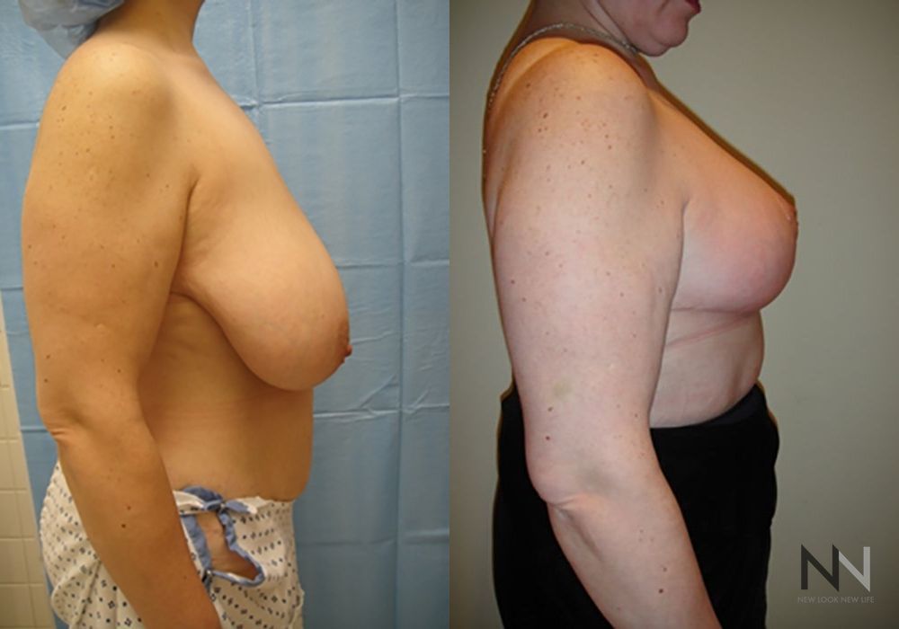 Breast Reduction - Thumbnail 4