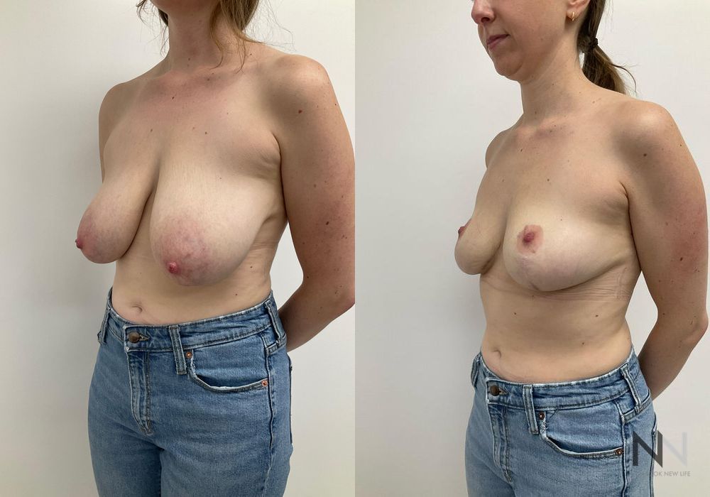 Breast Reduction - Thumbnail 2