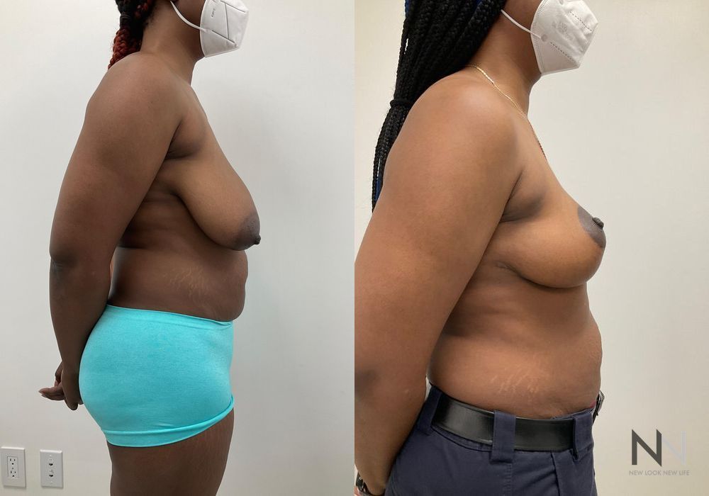 Breast Reduction - Thumbnail 3