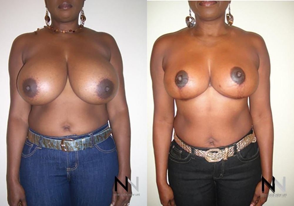 Breast Reduction - Case 2043