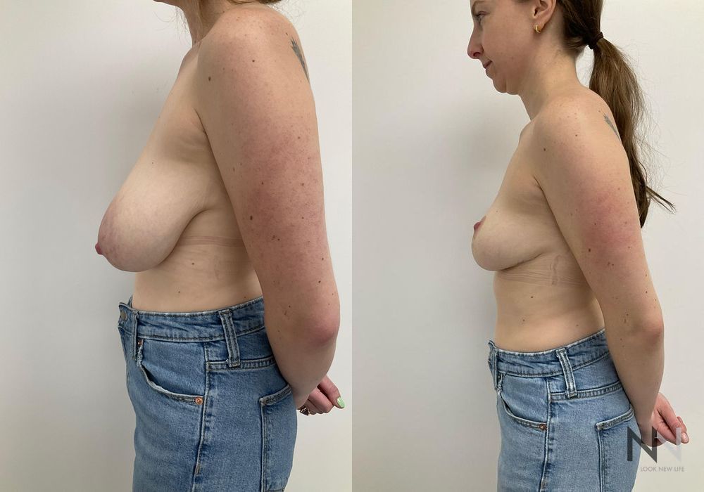 Breast Reduction - Thumbnail 3