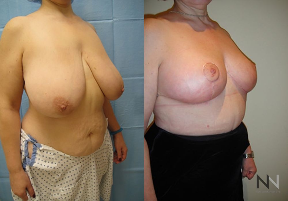 Breast Reduction - Case 1865