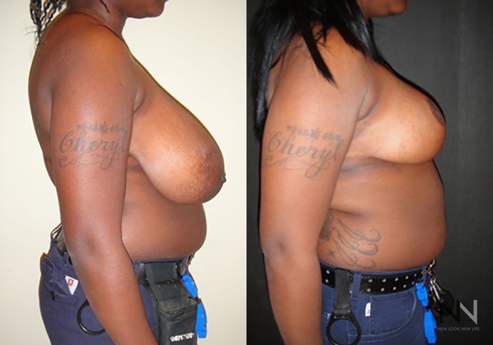 Breast Reduction - Thumbnail 5