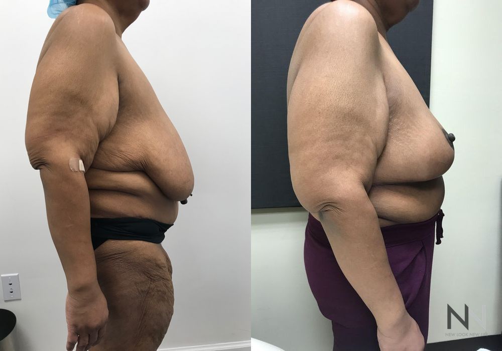 Breast Reduction - Thumbnail 3